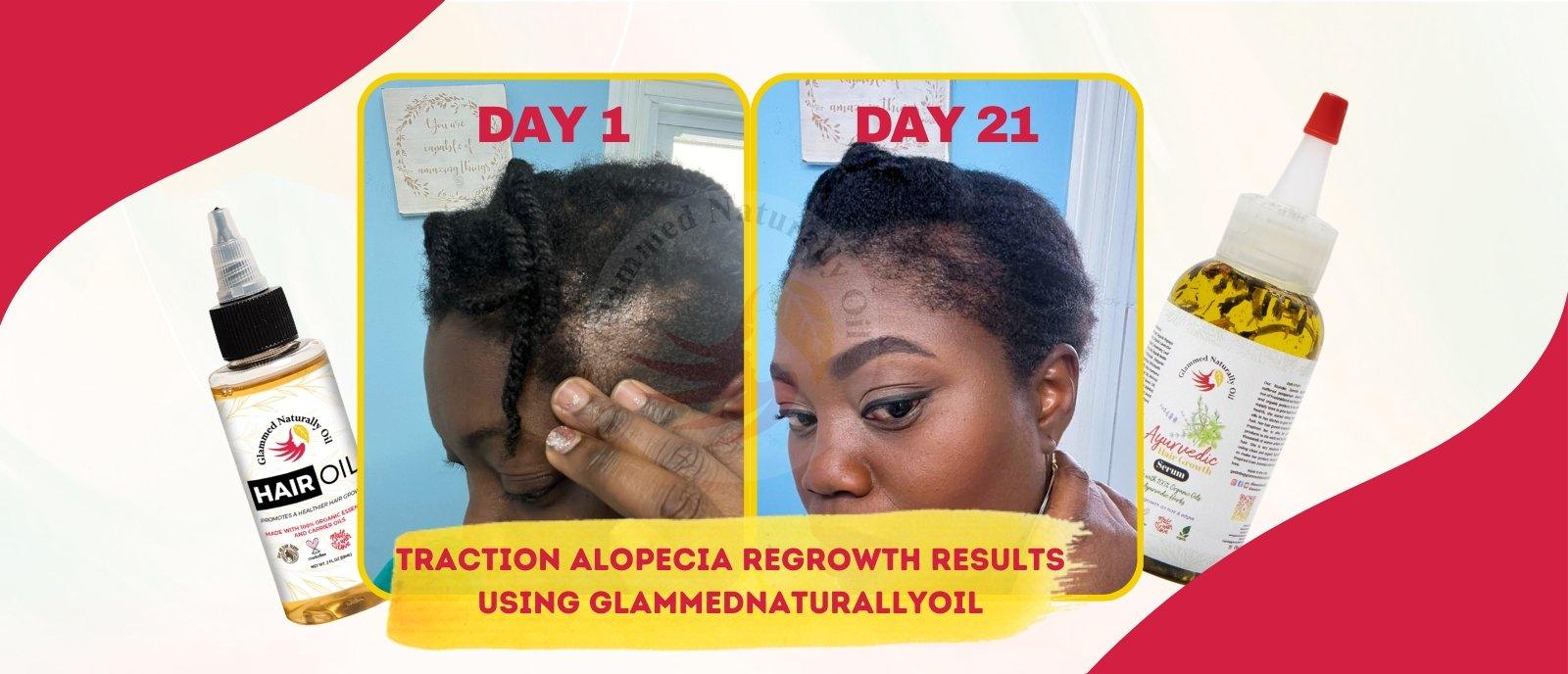 Traction alopecia before and after results - GlammedNaturallyOil